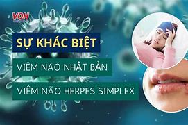 Viêm Não Do Virus Herpes Mất Hết Nhận Thức